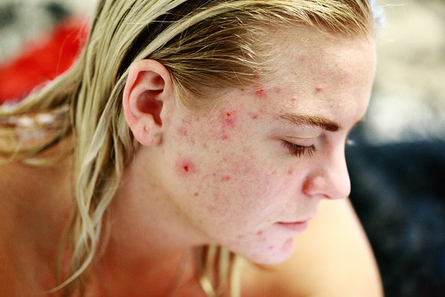 exemple d'acné modérée à sévère